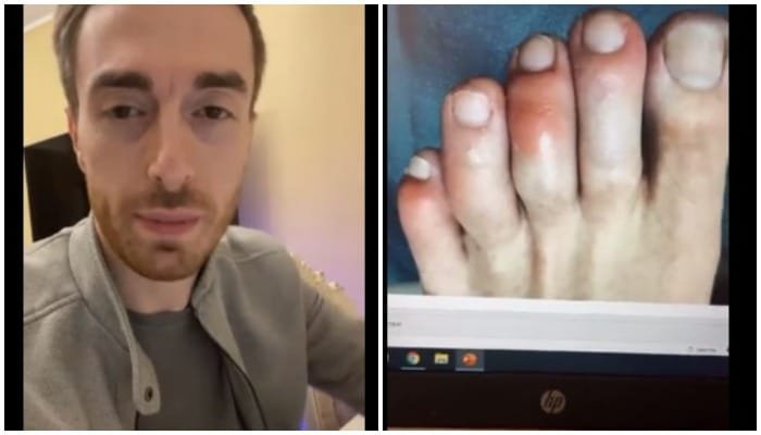 კორონავირუსის კიდევ ერთი ახალი  სიმპტომი