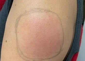 კორონავირუსის ვაქცინის გაკეთებიდან რამდენიმე დღის შემდეგ ადამიანთა ნაწილს გვერდითი ეფექტები გამოუვლინდა