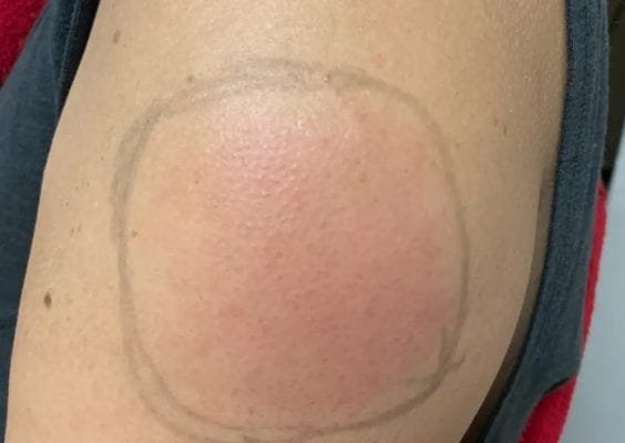 კორონავირუსის ვაქცინის გაკეთებიდან რამდენიმე დღის შემდეგ ადამიანთა ნაწილს გვერდითი ეფექტები გამოუვლინდა