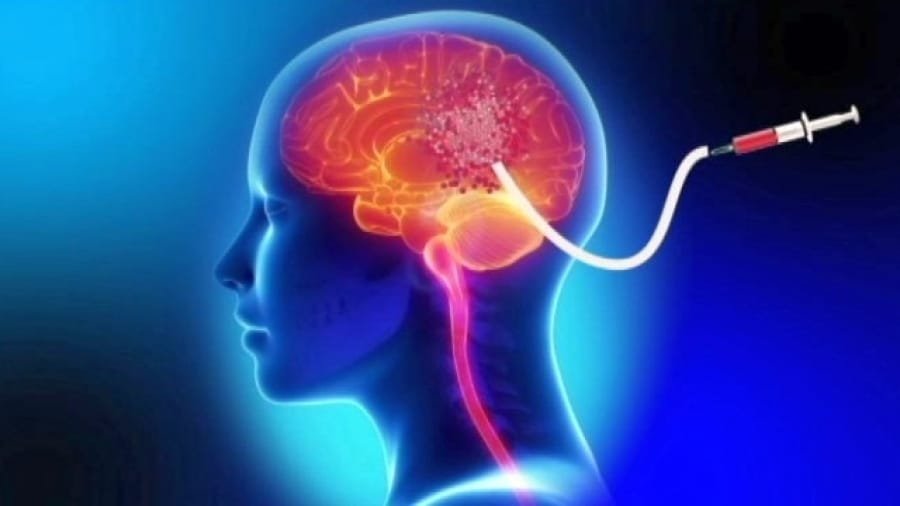 გერმანიაში ტვინის სიმსივნის საწინააღმდეგო ვაქცინა გამოსცადეს