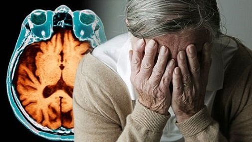 რა აღმოაჩინეს ალცჰაიმერით დაავადებული ადამიანების ტვინში