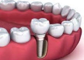 დედაშვილმა გაკეთებული კბილის იმპლანტები  დაჩიპვის შიშის გამო ამოიღო