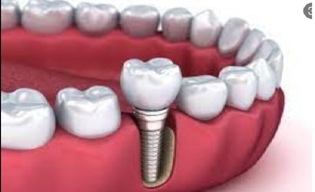 დედაშვილმა გაკეთებული კბილის იმპლანტები  დაჩიპვის შიშის გამო ამოიღო