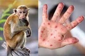 23 ივნისს ჯანმო იმსჯელებს წარმოადგენს თუ არა მაიმუნის ყვავილის ეპიდაფეთქება საერთაშორისო მნიშვნელობის საგანგებო სიტუაციას