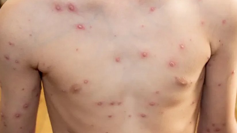 ნებისმიერი საეჭვო გამონაყარის შემთხვევაში მიმართეთ ოჯახის ექიმს-რას აცხადებს ეპიდემიოლოგი