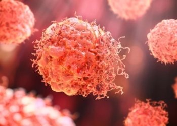 ექიმებმა „ჩუმი“ კიბოს მოულოდნელი სიმპტომი დაასახელეს