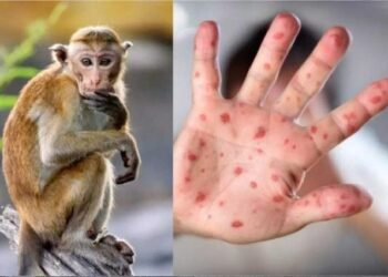 აზერბაიჯანში „მაიმუნის ყვავილით” ინფიცირების პირველი შემთხვევა დაფიქსირდა