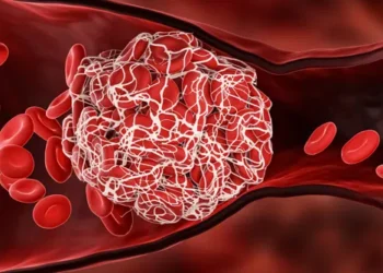 თრომბი და მასთან დაკავშირებული პრობლემები – როგორ დავიცვათ თავი ამ დაავადებისგან