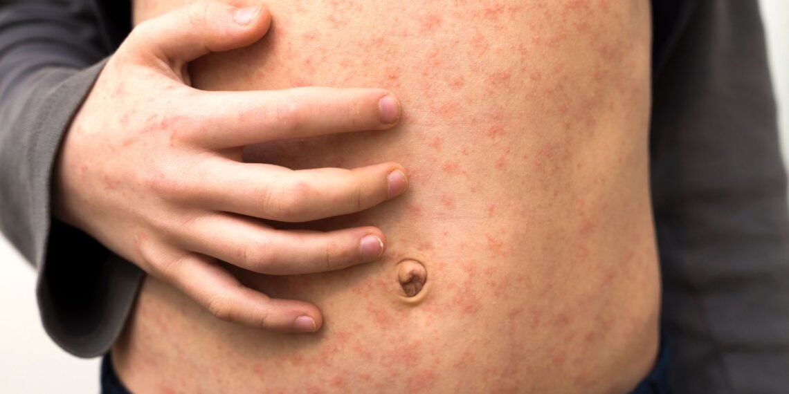 ბოლო 25 წლის განმავლობაში ევროპაში წითელას ყველაზე მაღალი მაჩვენებელი დაფიქსირდა