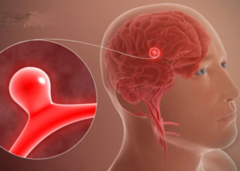 რა იწვევს თავის ტვინის ანევრიზმას – კვლევა