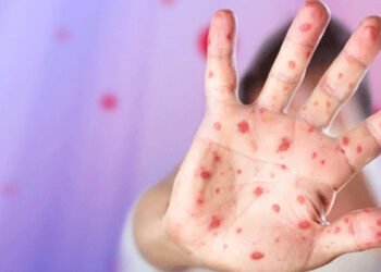 ტეხასის შტატში წითელას გავრცელების შედეგად ორი ბავშვი გარდაიცვალა