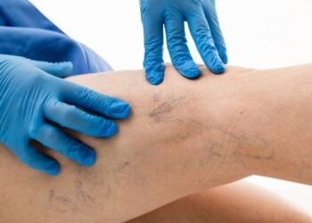 დასახელდა მთავარი ნიშნები, რითაც მიხვდებით, რომ სისხლძარღვებში საშიში თრომბი გაქვთ